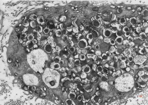 M,40y. | granular cell tumor M,40y. | granular cell tumor